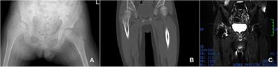 Case report: Glucose 6-phosphate-isomerase deficiency combine with avascular necrosis of bilateral femoral head